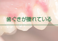 福岡県久留米市野中町・くろいわ総合歯科クリニック・歯ぐきが腫れている