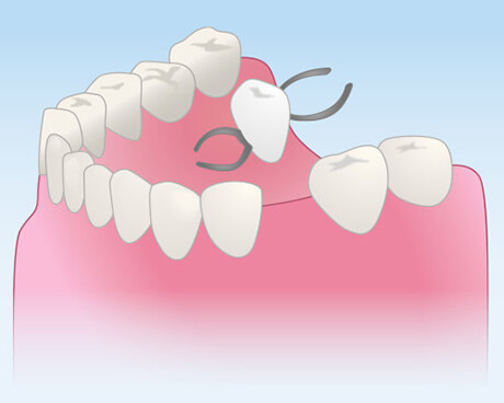 福岡県久留米市野中町・くろいわ総合歯科クリニック・局部入れ歯