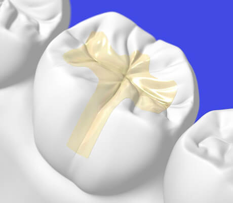 福岡県久留米市野中町・くろいわ総合歯科クリニック・レジン